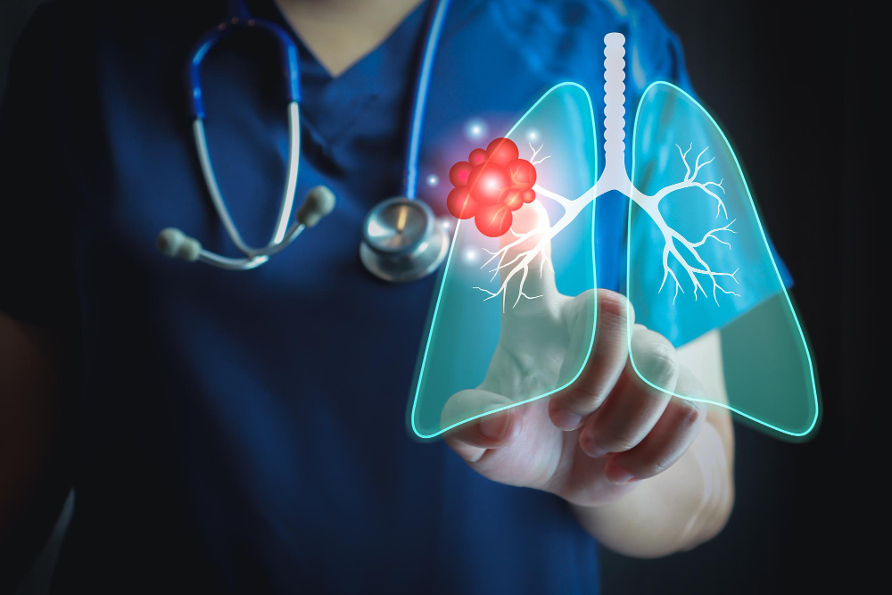 Lung Cancer Supportive Care